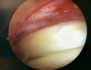 hip labrum surgery